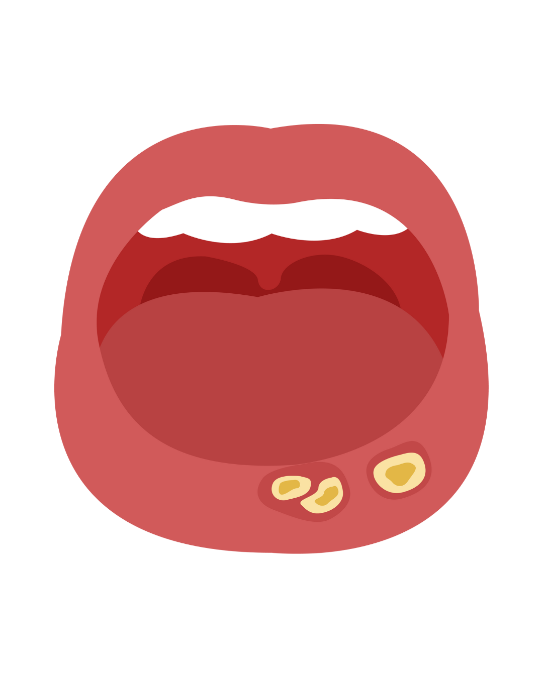 mouth ulcers, open mouth with ulceration from bowel disease, gut health, inflamed intestines, Crohn's, colitis, ulcerative colitis, how to heal naturally