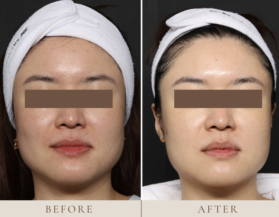 skin booster's benefit: Deep, Long-Lasting Hydration, Improved Skin Firmness and Texture,Subtle, Natural-Looking Glow