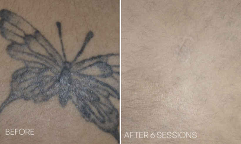 Close-up of laser tattoo removal treatment in progress, showing fading ink on skin as the device targets pigment for gradual clearance.