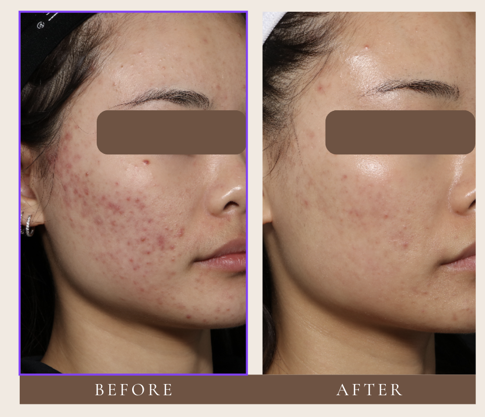 Close-up of acne laser treatment in progress, targeting inflamed breakouts to reduce bacteria, calm redness, and promote clearer skin.