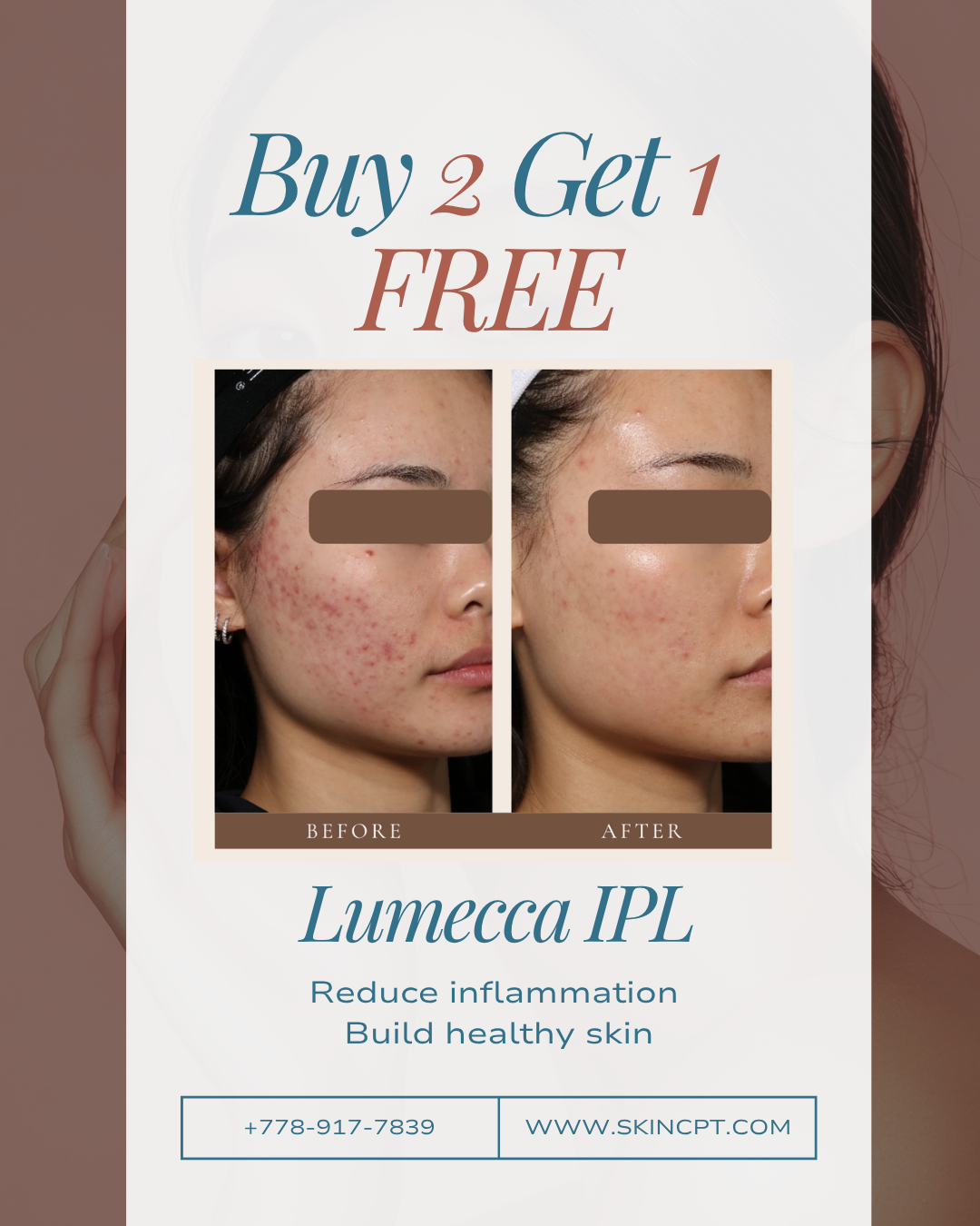 buy 2 get 1 free IPL in vancouver, reduce acne, brighten up skin, smooth skin texture