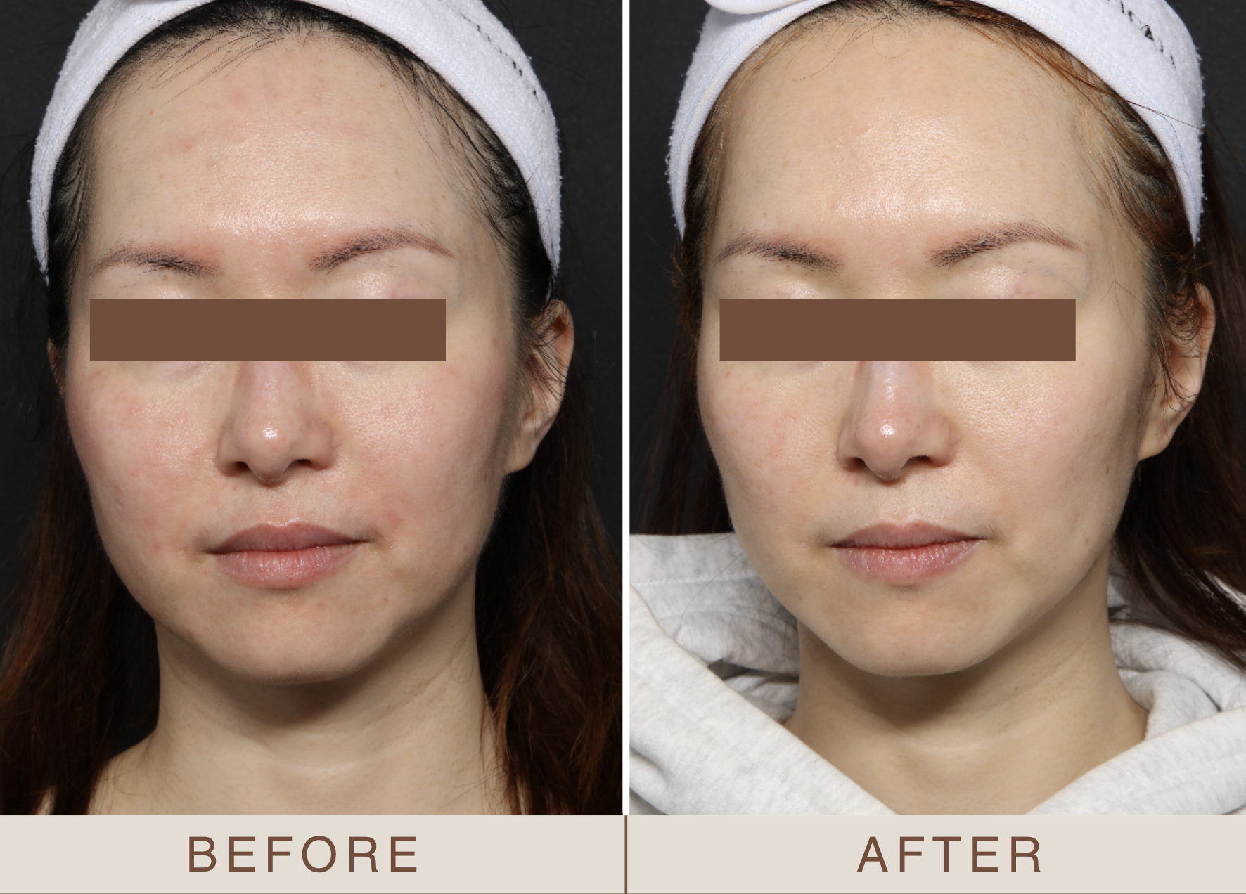 Lumecca IPL reduces redness, acne and post-inlammation, brighter, clearer complexion