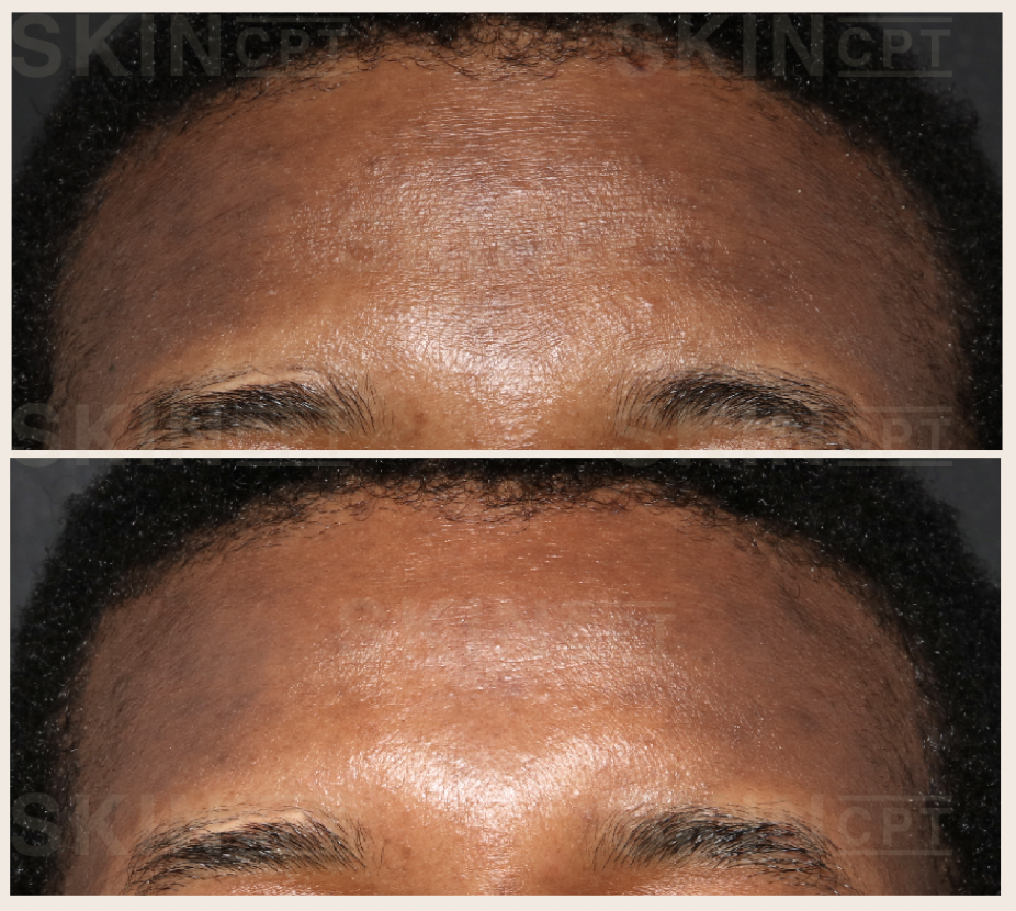 skin booster's benefit: Deep, Long-Lasting Hydration, Improved Skin Firmness and Texture,Subtle, Natural-Looking Glow