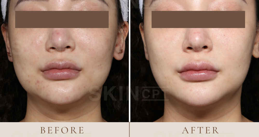 Helios III before & after photo shows a significant reduction in pigment intensity, with a more uniform skin tone and visibly clearer complexion.