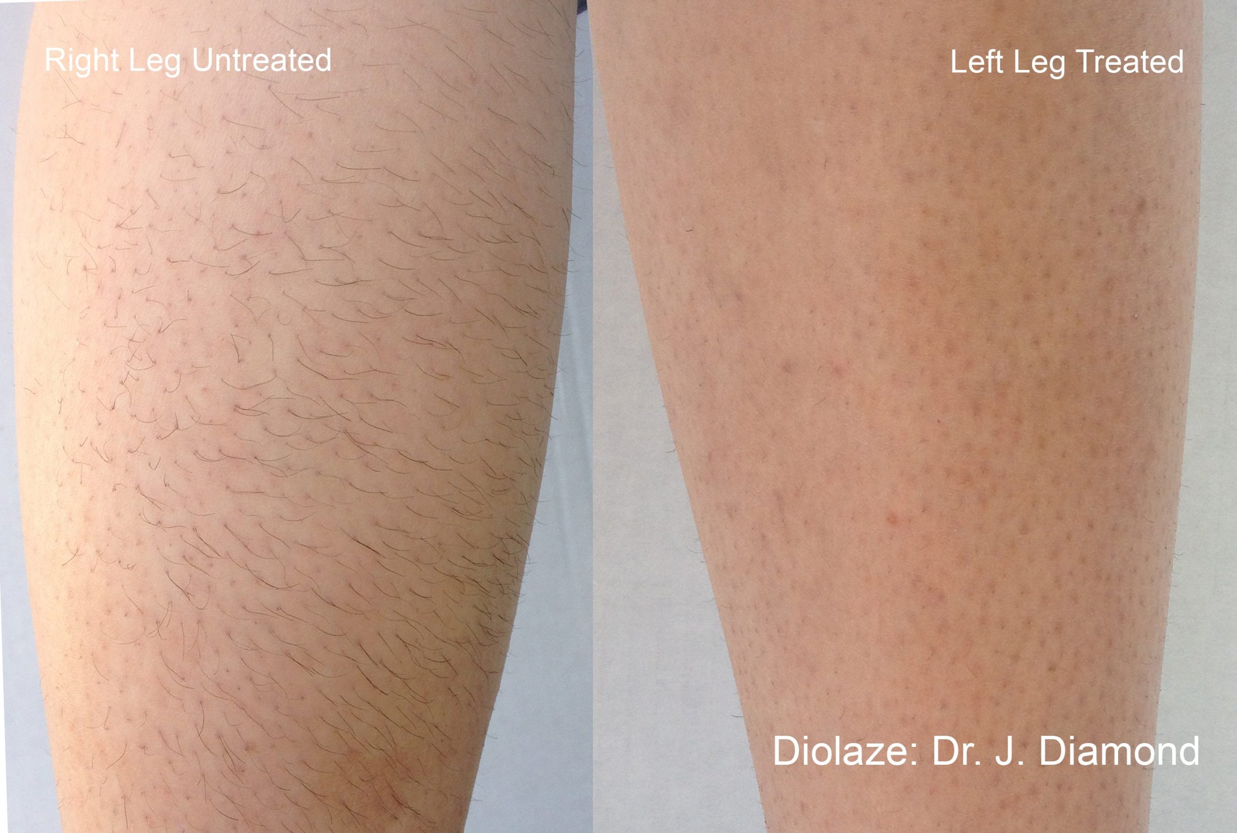 Inmode DiolazeXL Hair Removal before and afte
