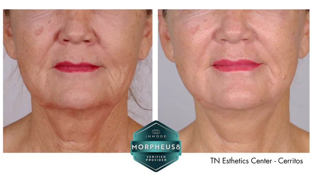 “Morpheus8 before and after results showing dramatic skin tightening, reduced wrinkles, and improved texture after just a few sessions.”