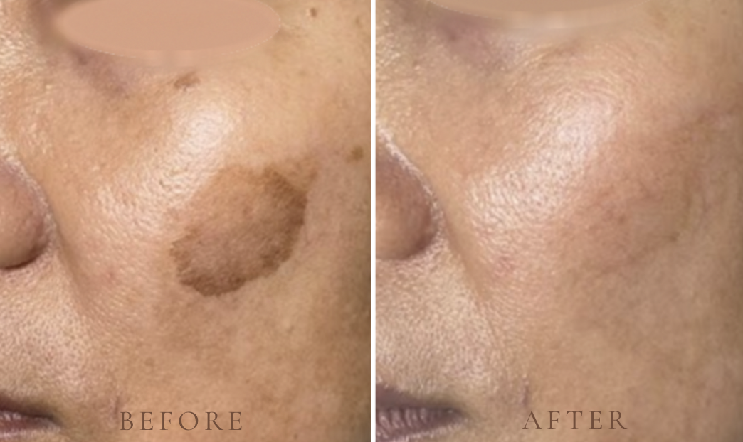 Helios III before & after photo shows a significant reduction in pigment intensity, with a more uniform skin tone and visibly clearer complexion.