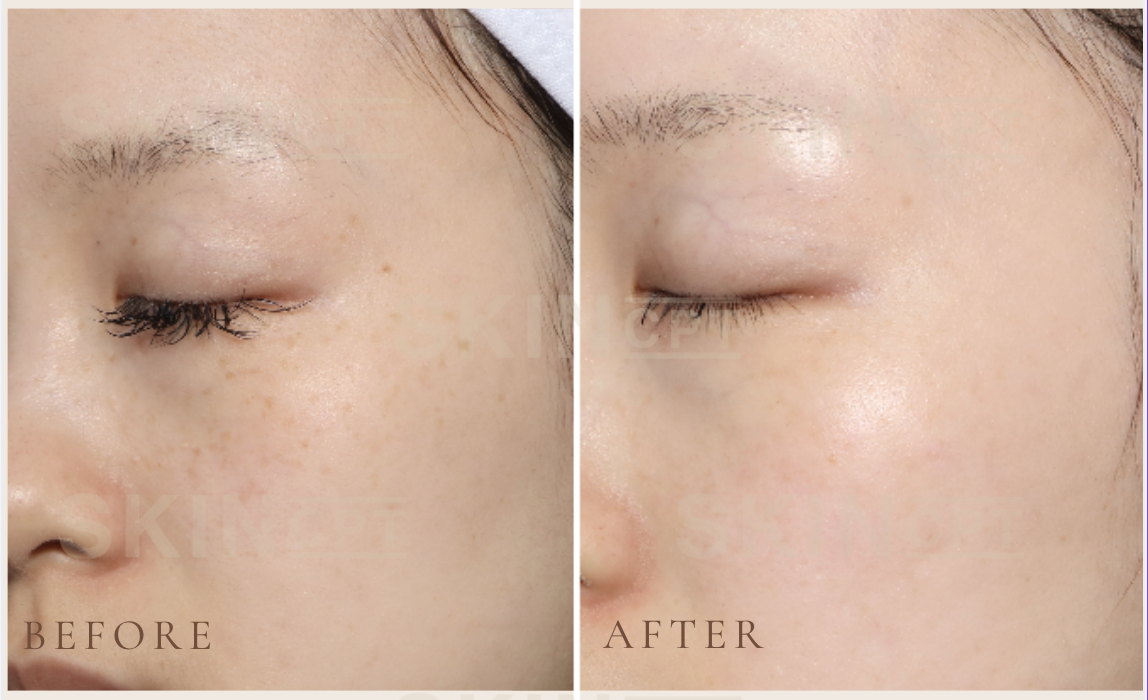 Helios III before & after photo shows a significant reduction in pigment intensity, with a more uniform skin tone and visibly clearer complexion.