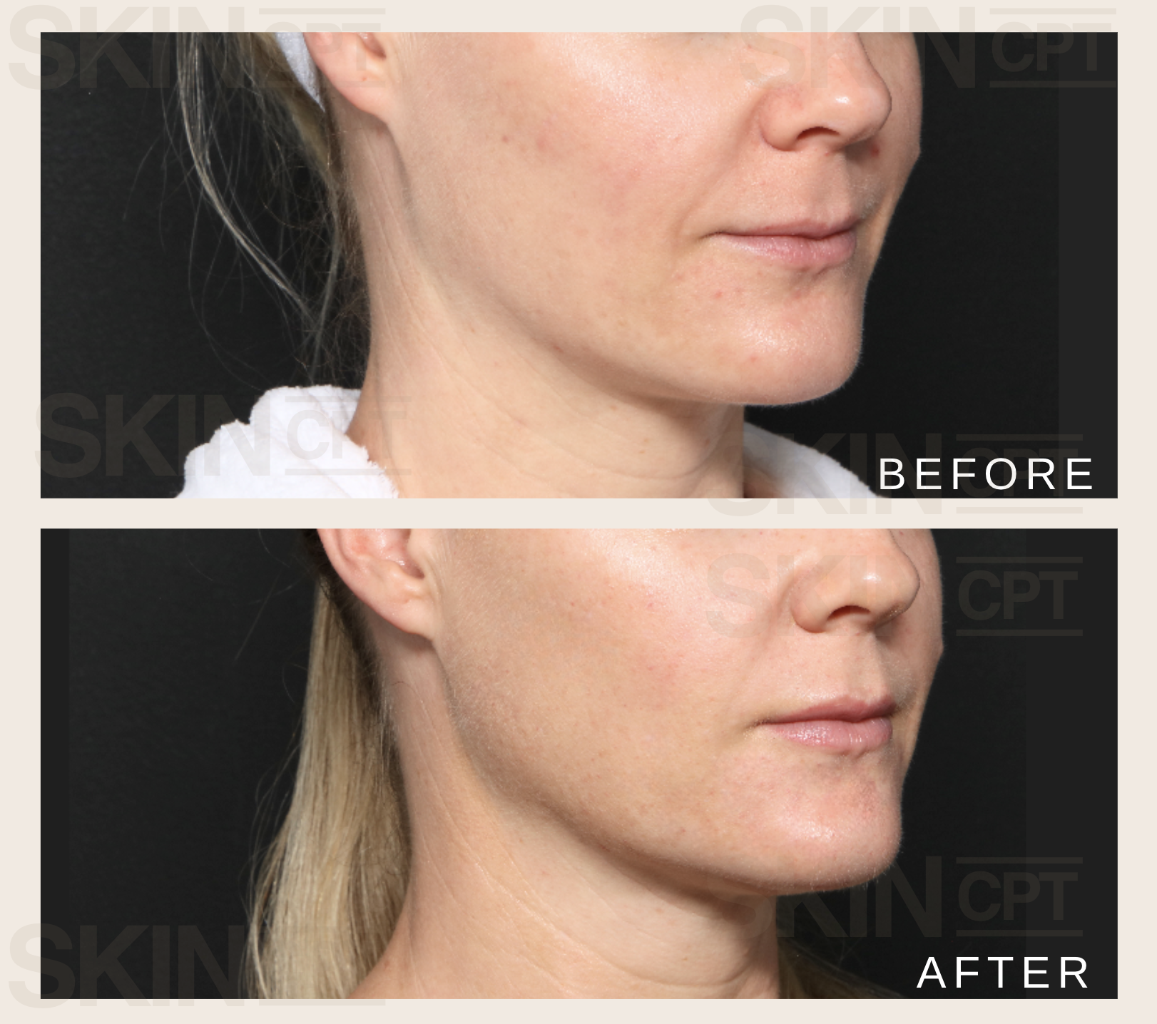 Morpheus8 before and after results at skincpt clinic show visible skin tightening and rejuvenation.