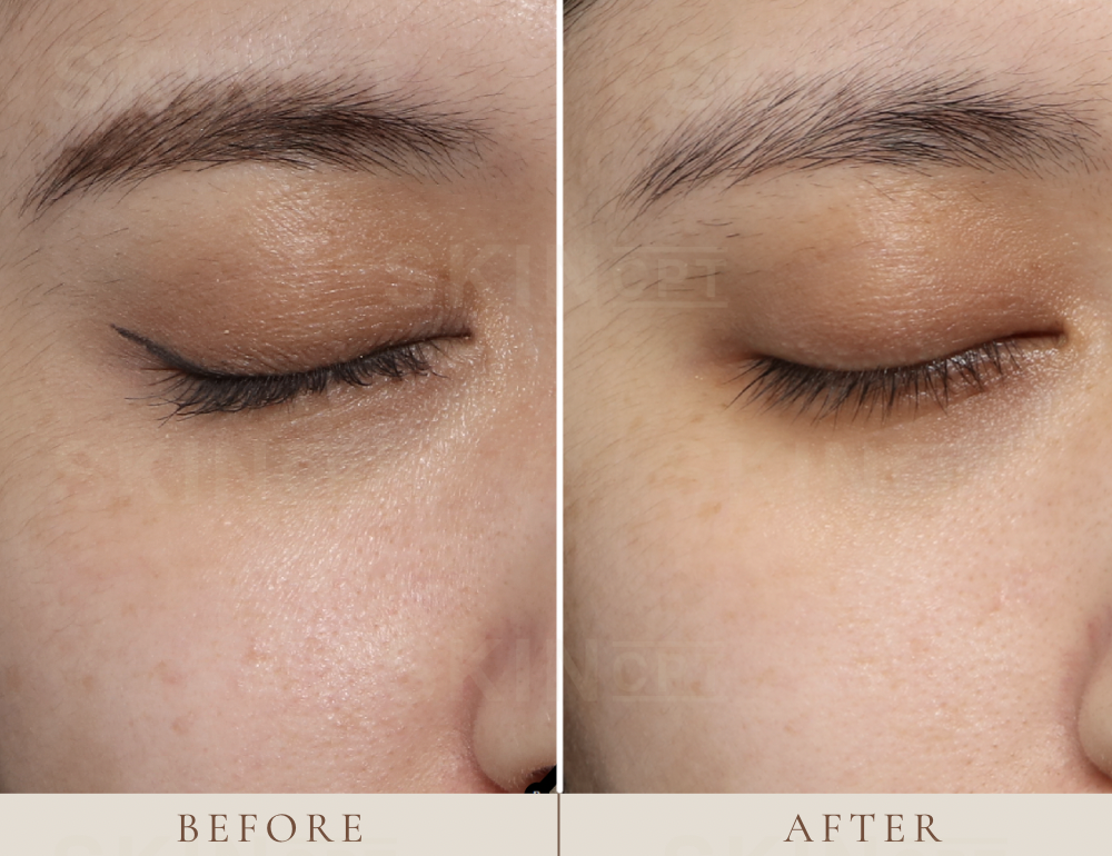 skin booster's benefit: Deep, Long-Lasting Hydration, Improved Skin Firmness and Texture,Subtle, Natural-Looking Glow