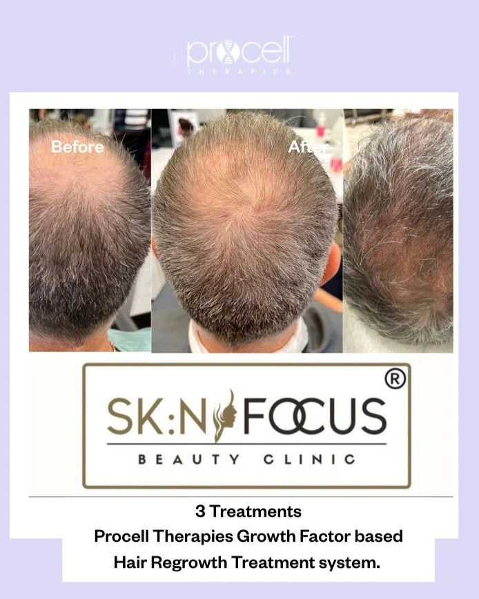 We are delighted to present results after 3 sessions from @skinfocus_urangan with Procell Therapies' Growth Factor-based Hair Regrowth Treatment system. Treatments can be performed at 2 weekly intervals with a recommended tip depth of 0.5mm.
This tr