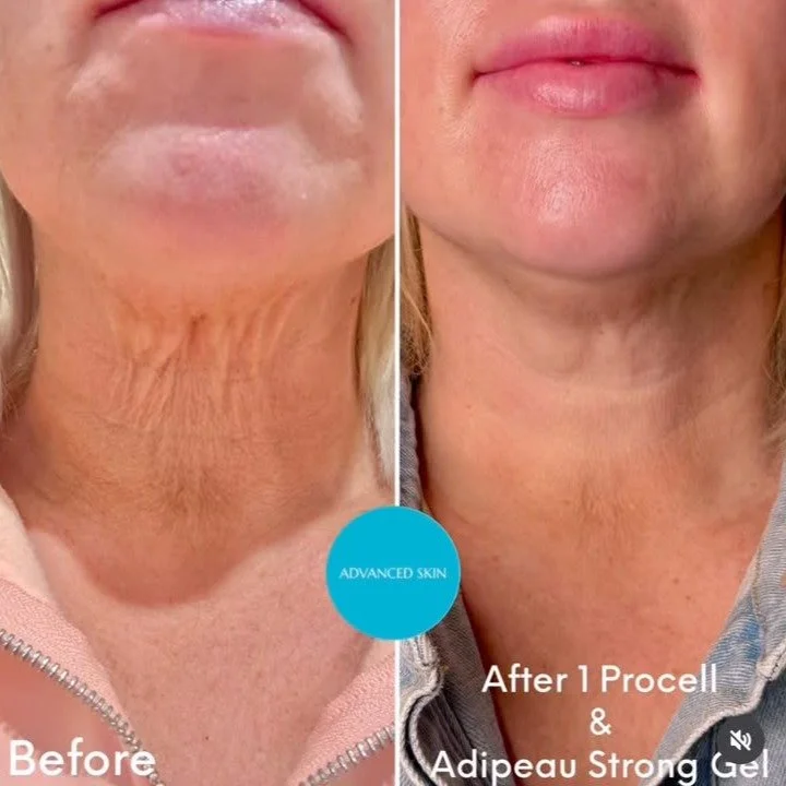 Progress photos too good not to share ððŦ
We are thrilled with the results after one treatment from @advanced_skin_by_summer using a combination of Procell Therapies Microchanneling with MD Delivery Serum, MD Step 1 and 2 Aftercare and Adipeau Stro