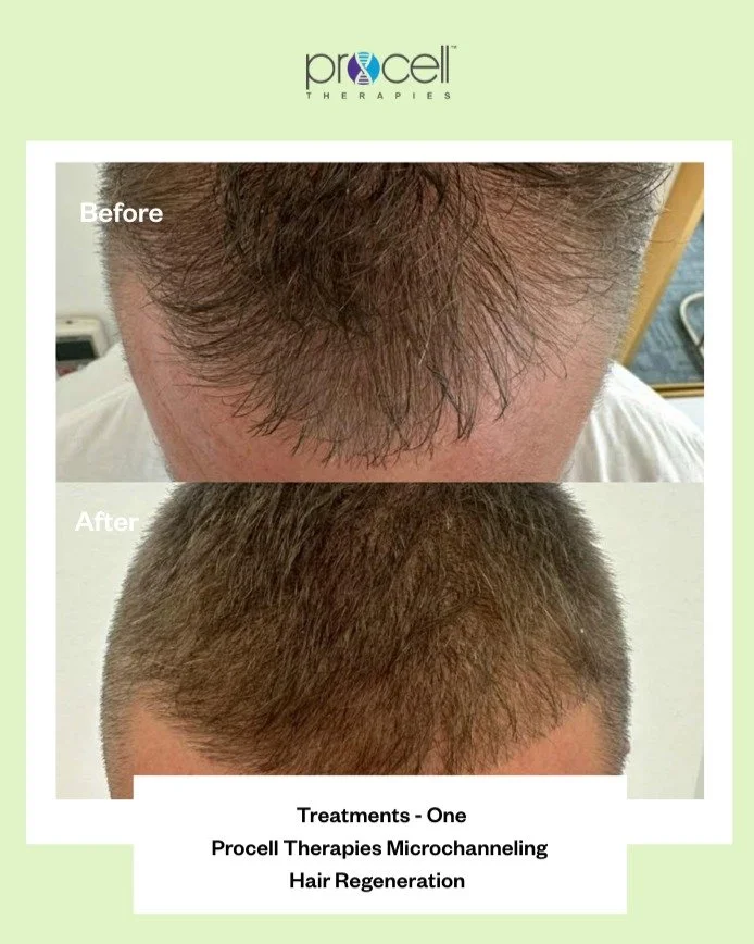 ðļ We are delighted to present this before-and-after photo of just ONE ProCell Hair Growth Microchanneling treatment courtesy of @townsvilleantiaging and their patient!
âĻ Thicker, Fuller Hair Starts with Procell – Naturally. âĻ
If you have pat