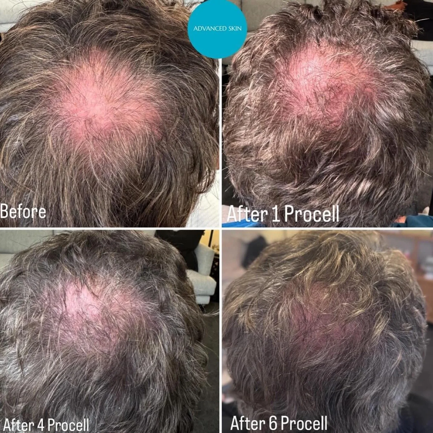 PROCELL HAIR RESTORATION! Transform Your Hair, Transform Your Confidence! âĻð
We are delighted to share results from @advanced_skin_by_summer after a Procell Hair Package which features Procell's Microchanneling device using a 0.5mm treatment tip, o