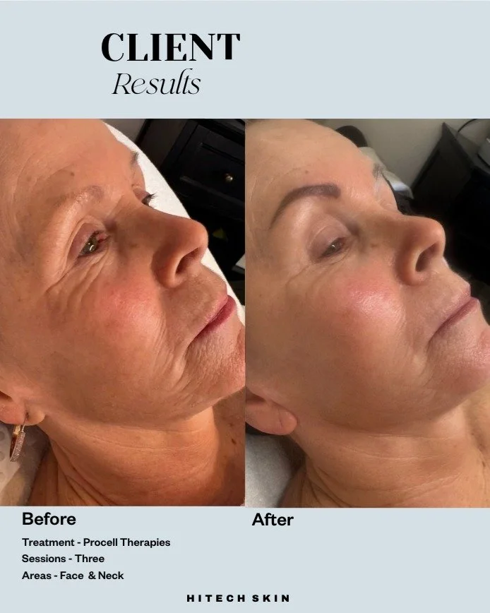 Transformation Tuesday with Procell Therapies Microchanneling ð
My beautiful client kindly allowed me to share her incredible results. We're currently doing a series of 6 treatments, 4 weeks apart, and we're both blown away with how it's improved t