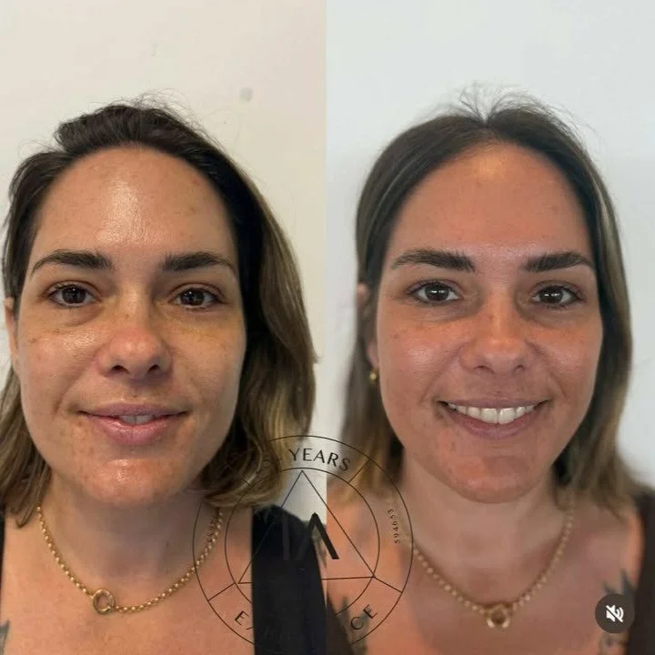 We are delighted to present before and after results from @imageaesthetics_gc following 1 Procell Therapies Microchanneling Treatment in conjunction with use of Procell's Step 1 and 2 Aftercare System.
At this early stage we are noticing cellular re