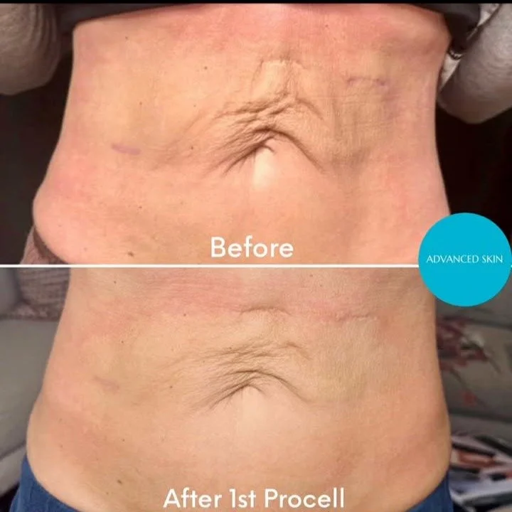 We are overjoyed to share this incredible result for skin tightening on the body from @advanced_skin_by_summer following ONE Procell Microchanneling Treatment as part of a package of 3 on her gorgeous client. 
Surgical scars have also dramatically i