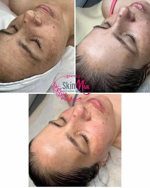 We are delighted to present results after 1 Procell Therapies Microchanneling treatment at a depth of 0.25mm using our PRO grade treatment serum from skin.mia for treating her lovely bride to be client with Melasma.
Procell is ideal for treating Mel