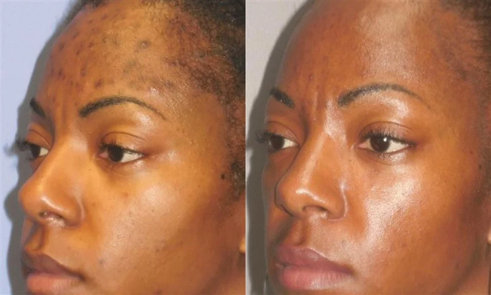 Side-by-side comparison of a woman's face showing improved skin condition, with the left side displaying acne scars and pigmentation, and the right side showing clearer, smoother skin.
