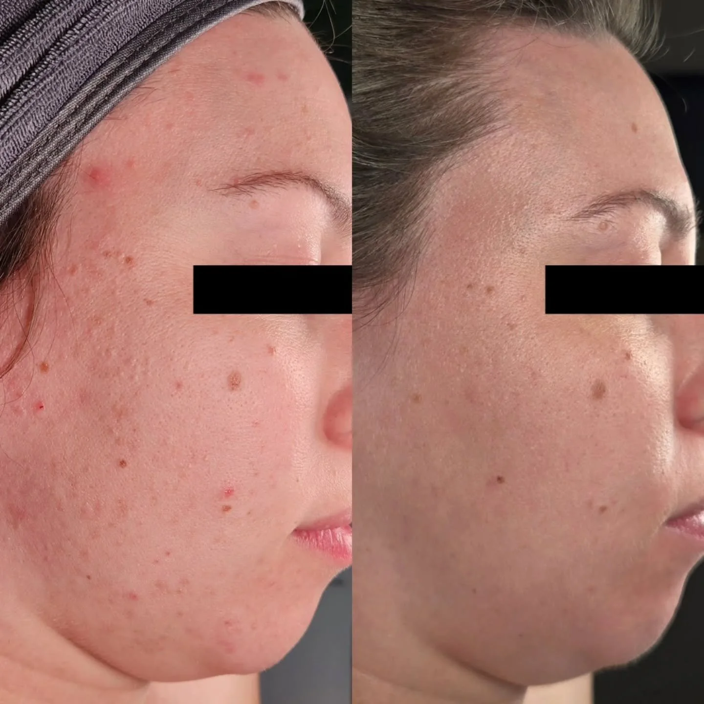 Acne hurts. It hurts mentally and physically. It can make you feel alone and worried that nothing will ever work.

But you deserve skin that lets you feel confident again.

So how did we get results like these?
Commitment, trust, and time 🙌

Clear s