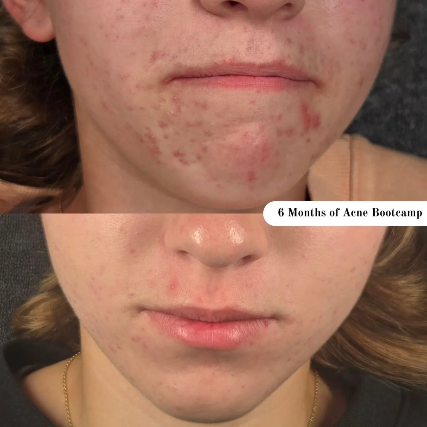 Acne takes over every part of you.

It changes the way you look in the mirror, the way you feel when you walk into a room, and the way you talk to yourself inside your head.

You start believing things like:
&bull; &ldquo;It&rsquo;s my fault.&rdquo;
