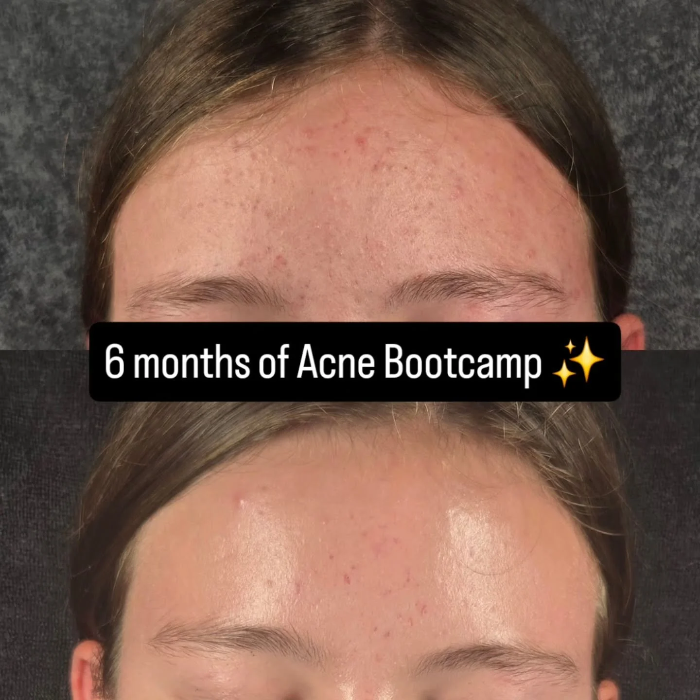 Clearing acne is HARD!

It takes: 
&bull; Patience for discovering your acne triggers
&bull; Communication between you and I
&bull; &amp; Dedication to your daily homecare 

What works for one client is NOT what is going to work for someone else stru