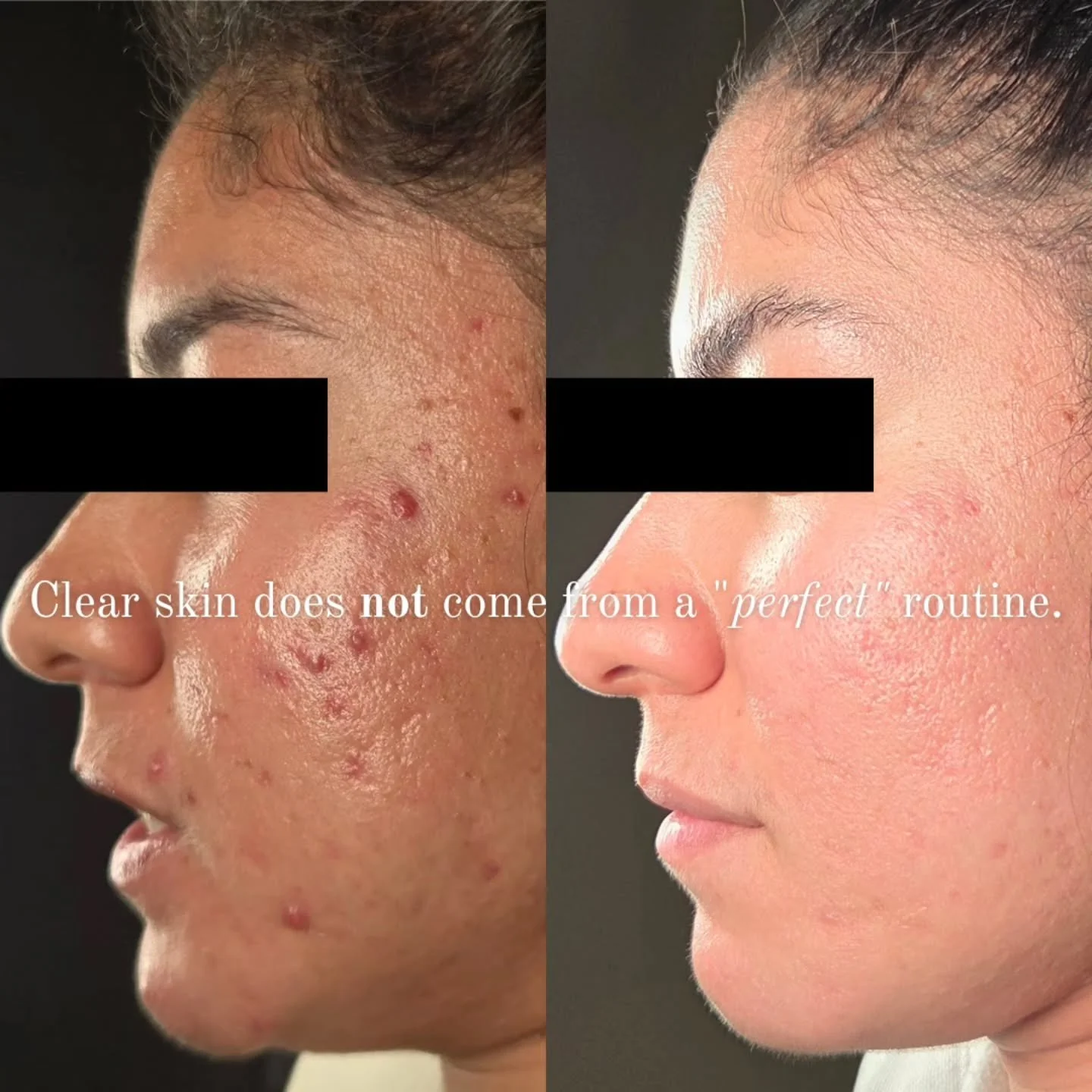 Your acne is not unfixable. Your approach is incomplete.

Clear skin happens when the daily pieces stop working against each other.

Skincare, haircare, hygiene products, food choices, stress levels, sleep, &amp; consistency all matter.

When one sta