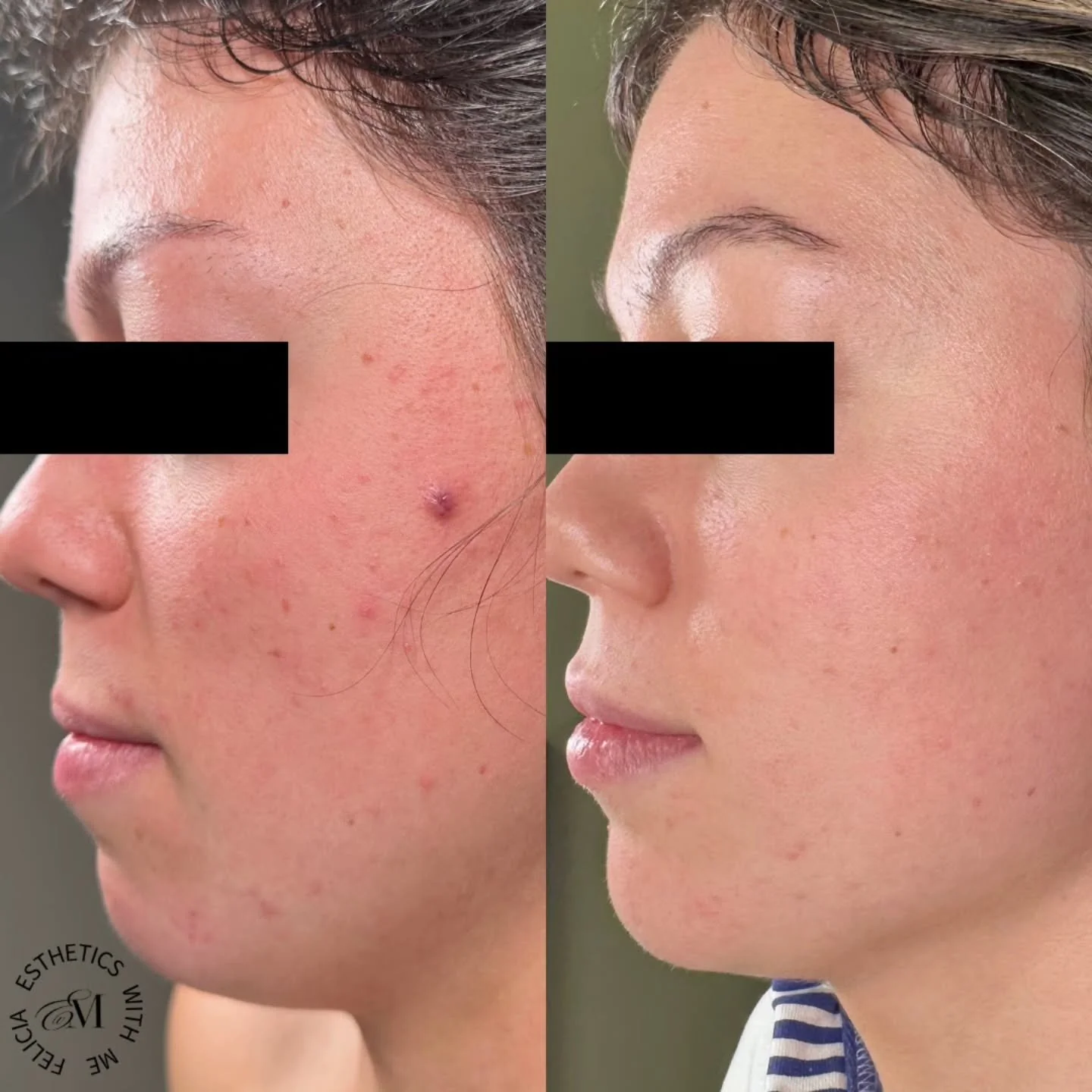 Felicia, one of our estheticians - in her element - &amp; changing skin 💜

These photos are 18 months apart.

When she first came in, the clients skin felt unpredictable. 

She struggled with:
👉 Breakouts
👉 Texture
👉 Nothing really settling. 

Th