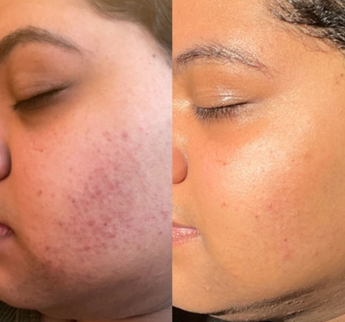Virtual Acne Help