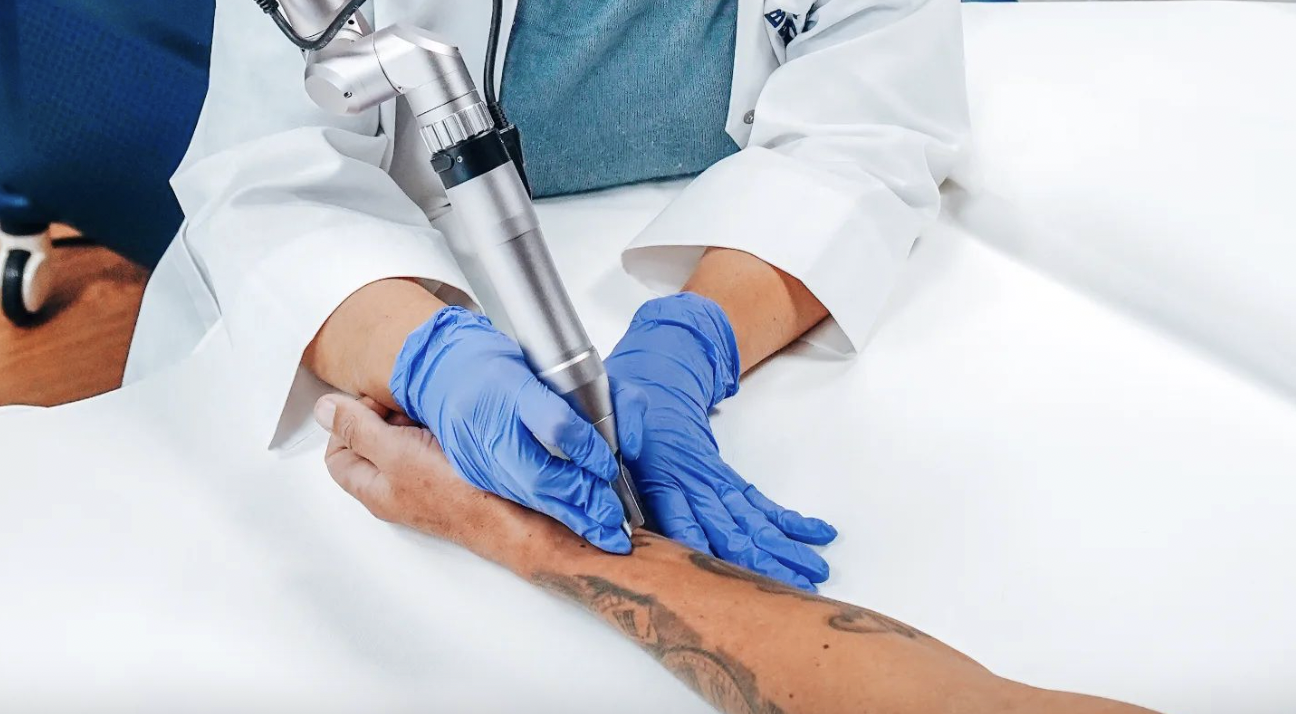 L’art du détatouage par Bye Bad Tattoo