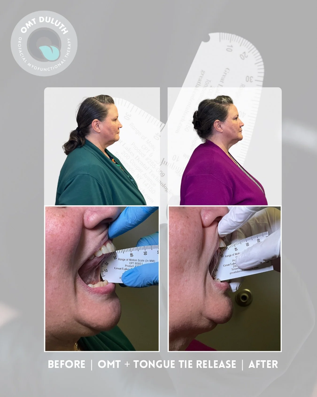 Before &amp; after of our patient who completed OMT and a tongue tie release and reports huge improvement in neck pain &amp; tension. She stated, &ldquo;I am really happy, I recommend you to everyone especially if they have sleep apnea.&rdquo; We&rsq