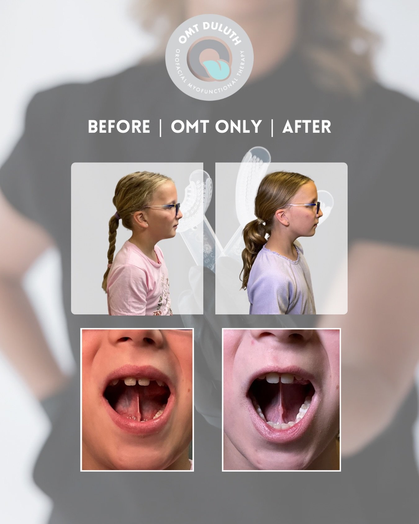 This patient is 9 years old and has had OMT here inside @omtduluth @mountroyaldental , with no tie releases. Patient&rsquo;s initial concern was having trouble with &ldquo;R&rdquo; sounds but did not qualify for speech therapy.

Throughout her OMT pr