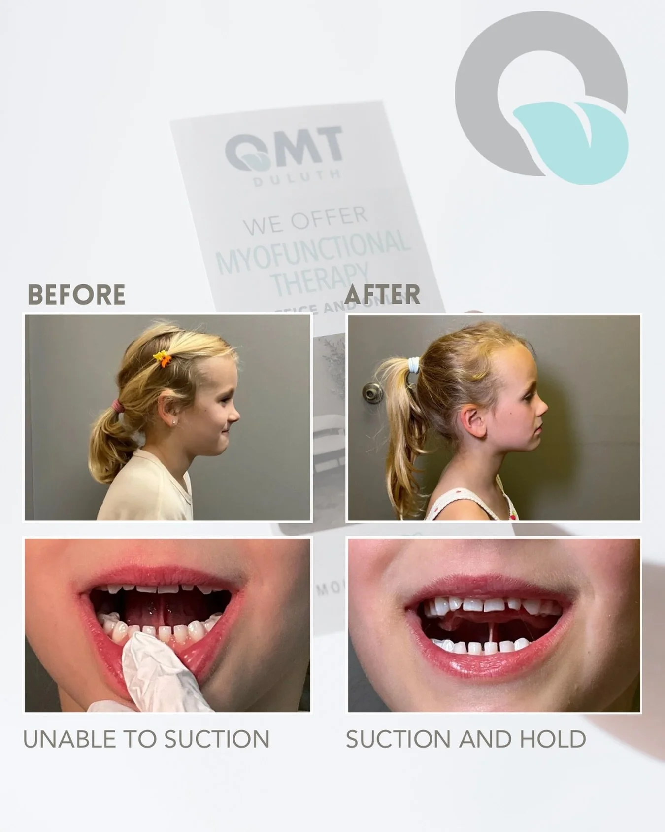 We are so excited for this patient&rsquo;s progress. We&rsquo;ve seen:

&bull; Improved breathing patterns (mom reports quiter sleeping) 
&bull; Stronger Oral Posture and tongue function
&bull; Better Jaw aligment and mobility
&bull; Improved neck / 