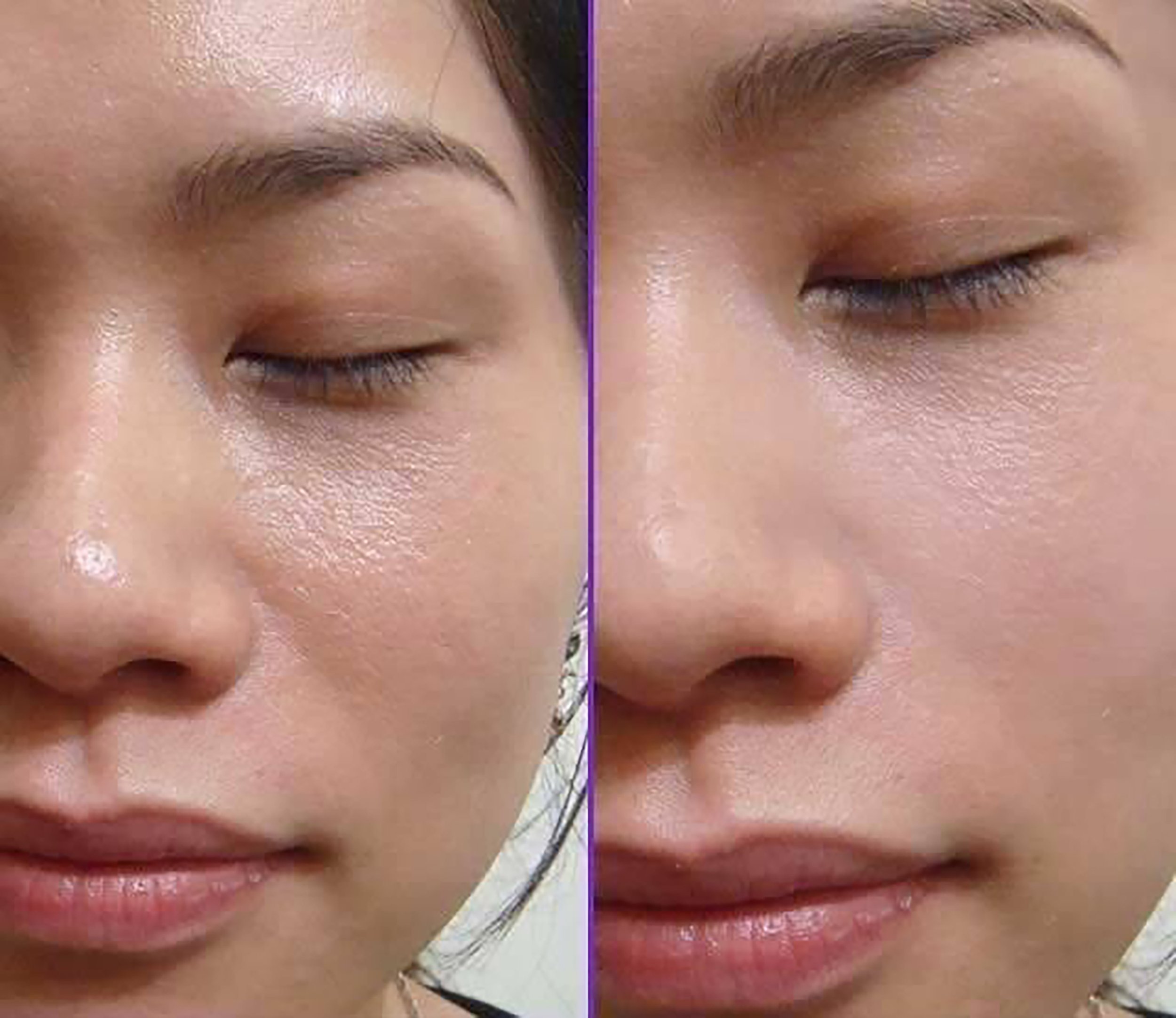 hifu skin tightening