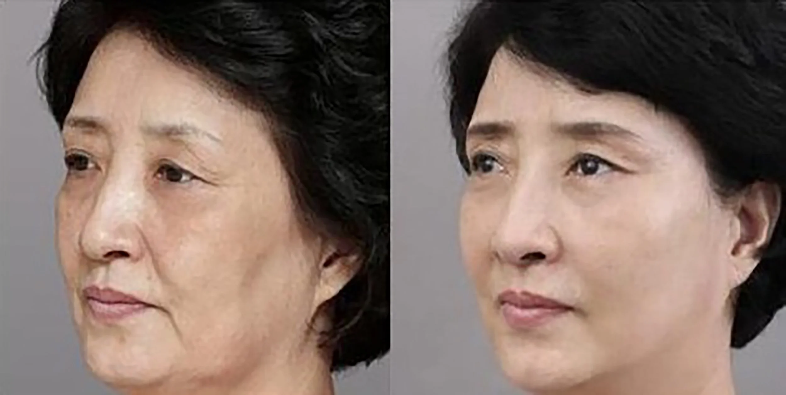 Hifu Facelift