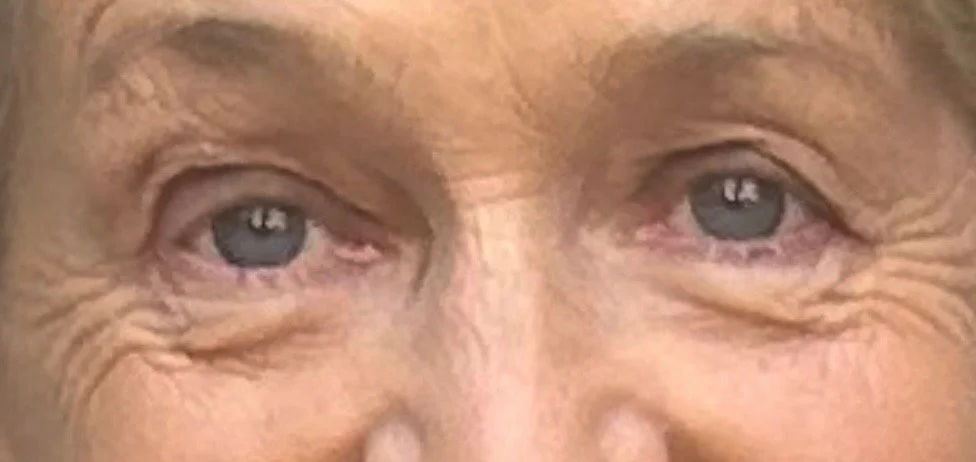 Bright Eyes, Timeless Beauty: Your Guide to Eye Rejuvenation