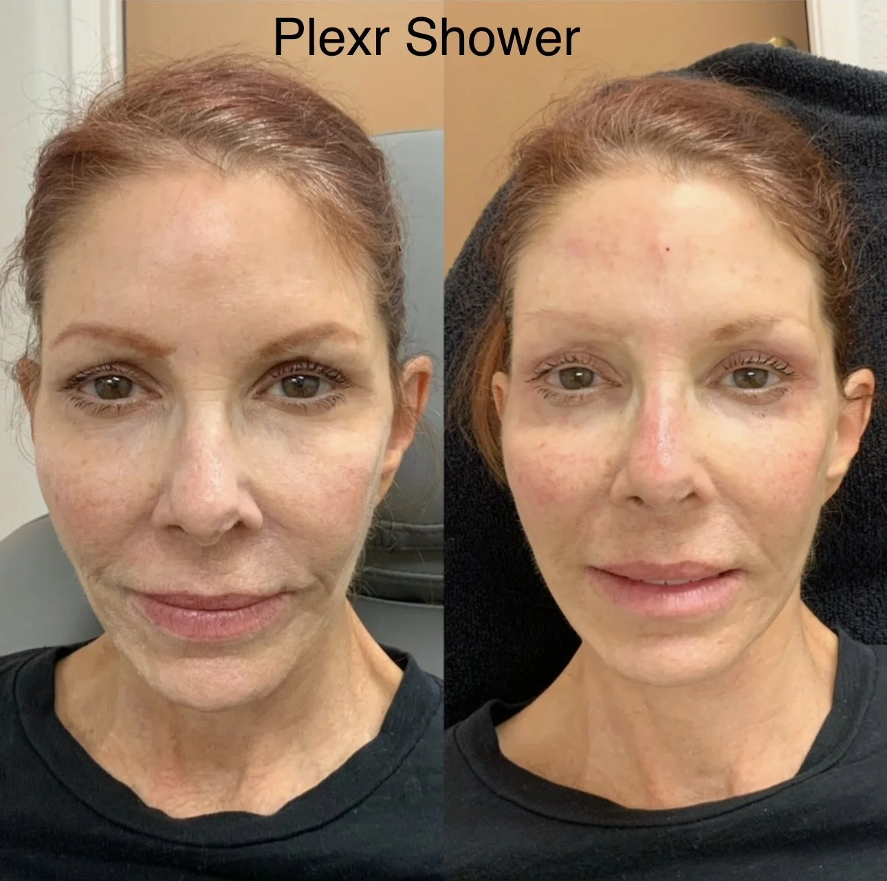 Before and after PLEXR Shower facial treatment showing eye brow lift,  improvement in skin texture and overall appearance.