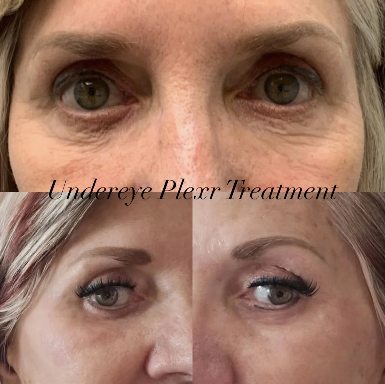 Before and after images showing the results of an under-eye Plexr treatment, with the top image illustrating under-eye bags and wrinkles, and the bottom images showing smoother, more youthful under-eye areas.