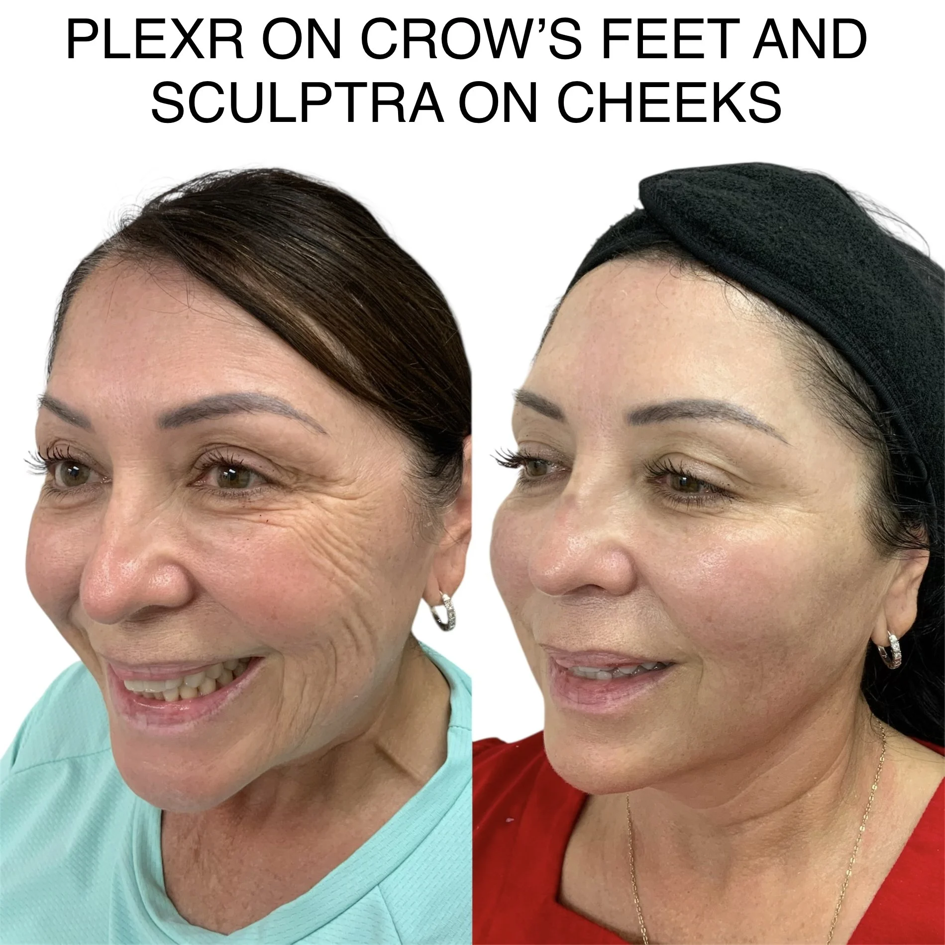 Before and after Sculptra treatment to the cheeks and PLEXR Plus around the eyes for facial rejuvenation