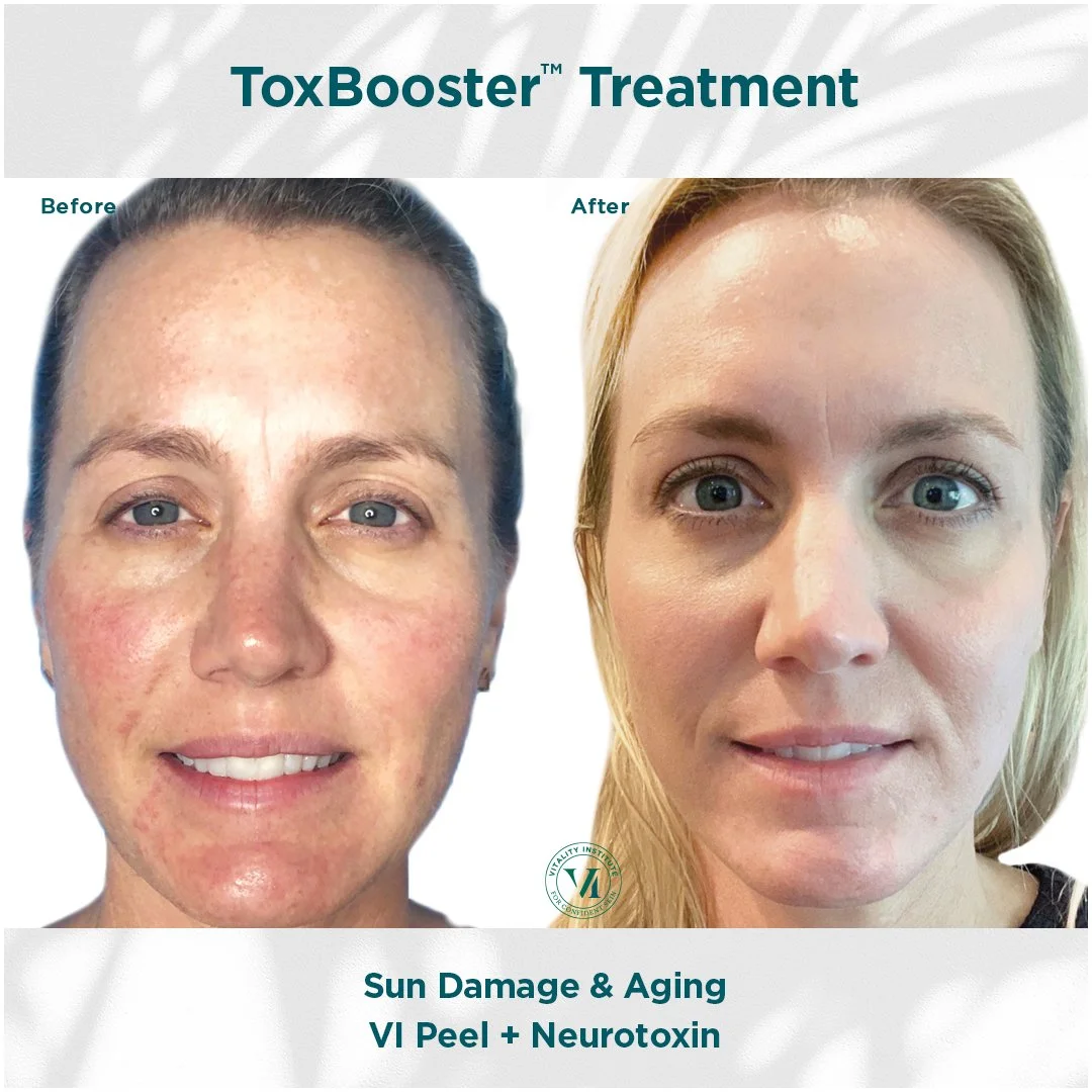 Before and after VI Peel ToxBooster treatment showing improvement in sun damage and overall skin appearance at Rain Aesthetics in Glendale, AZ.