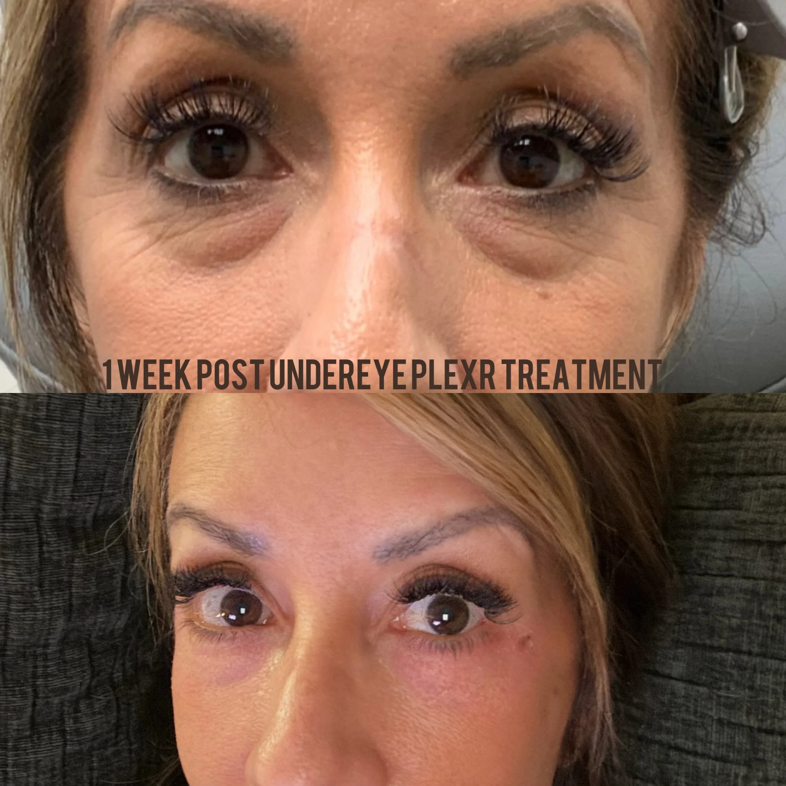 Before and after under-eye rejuvenation showing improvement in the appearance of the under-eye area.