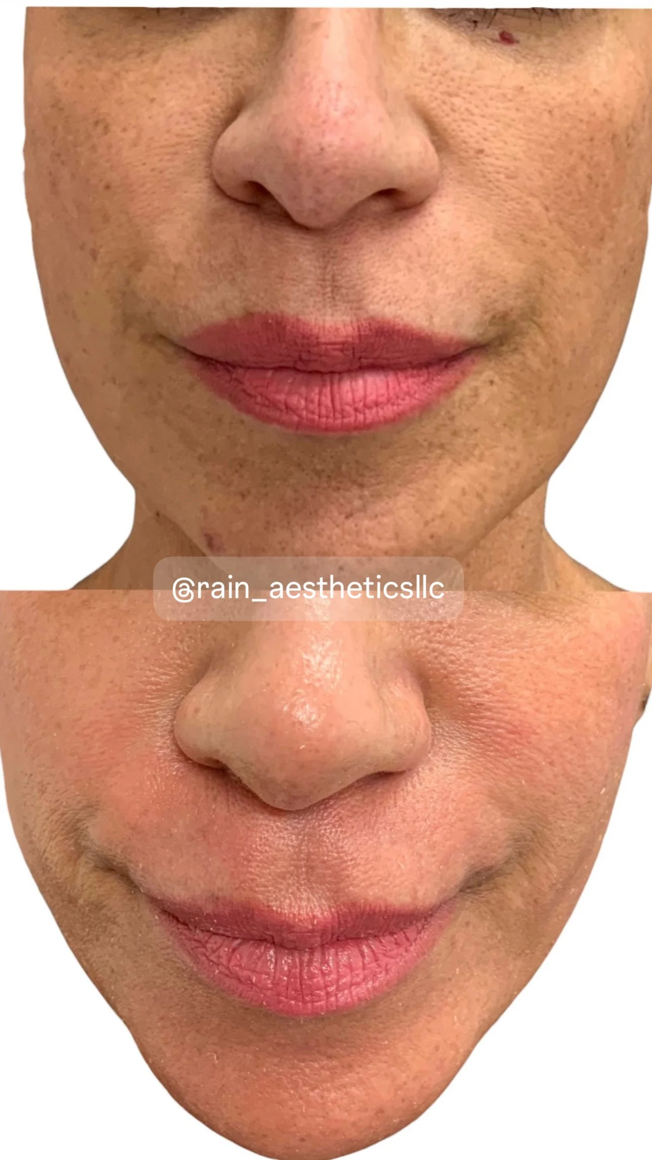 Before and after SkinPen microneedling showing improvement in skin texture and appearance at Rain Aesthetics in Glendale, AZ.