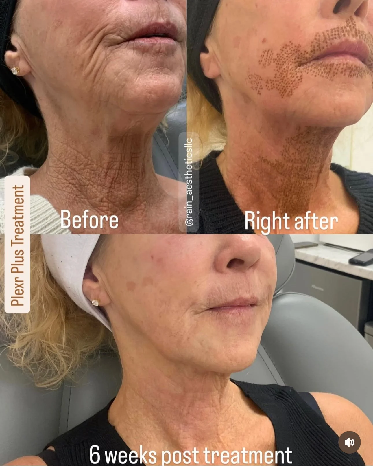 Before, immediately after, and 6-week results of PLEXR Plus plasma treatment for lower-face and perioral skin rejuvenation in Glendale, AZ.