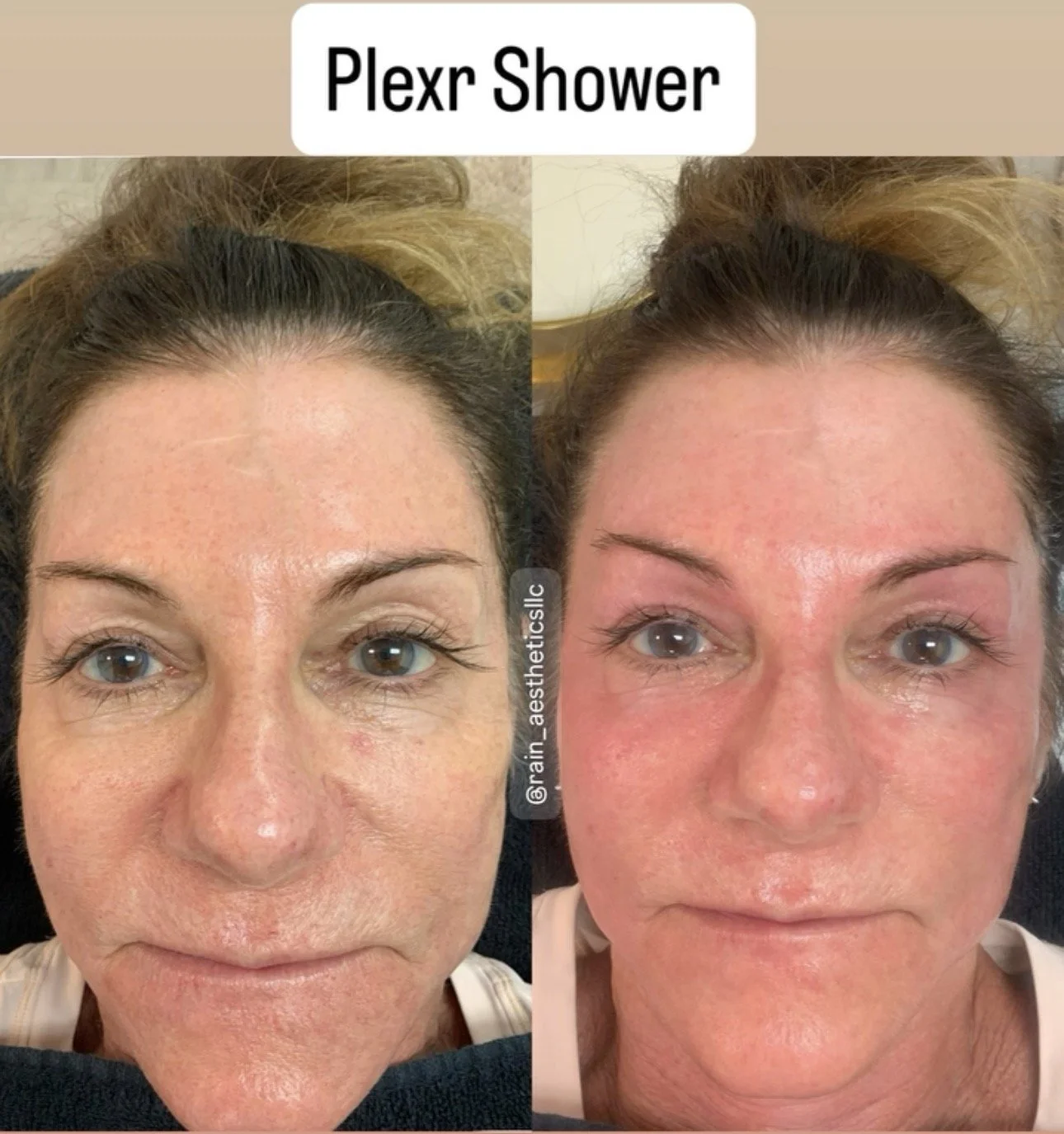 Before and after PLEXR Shower treatment showing improved facial skin texture and rejuvenation at Rain Aesthetics in Glendale, AZ.