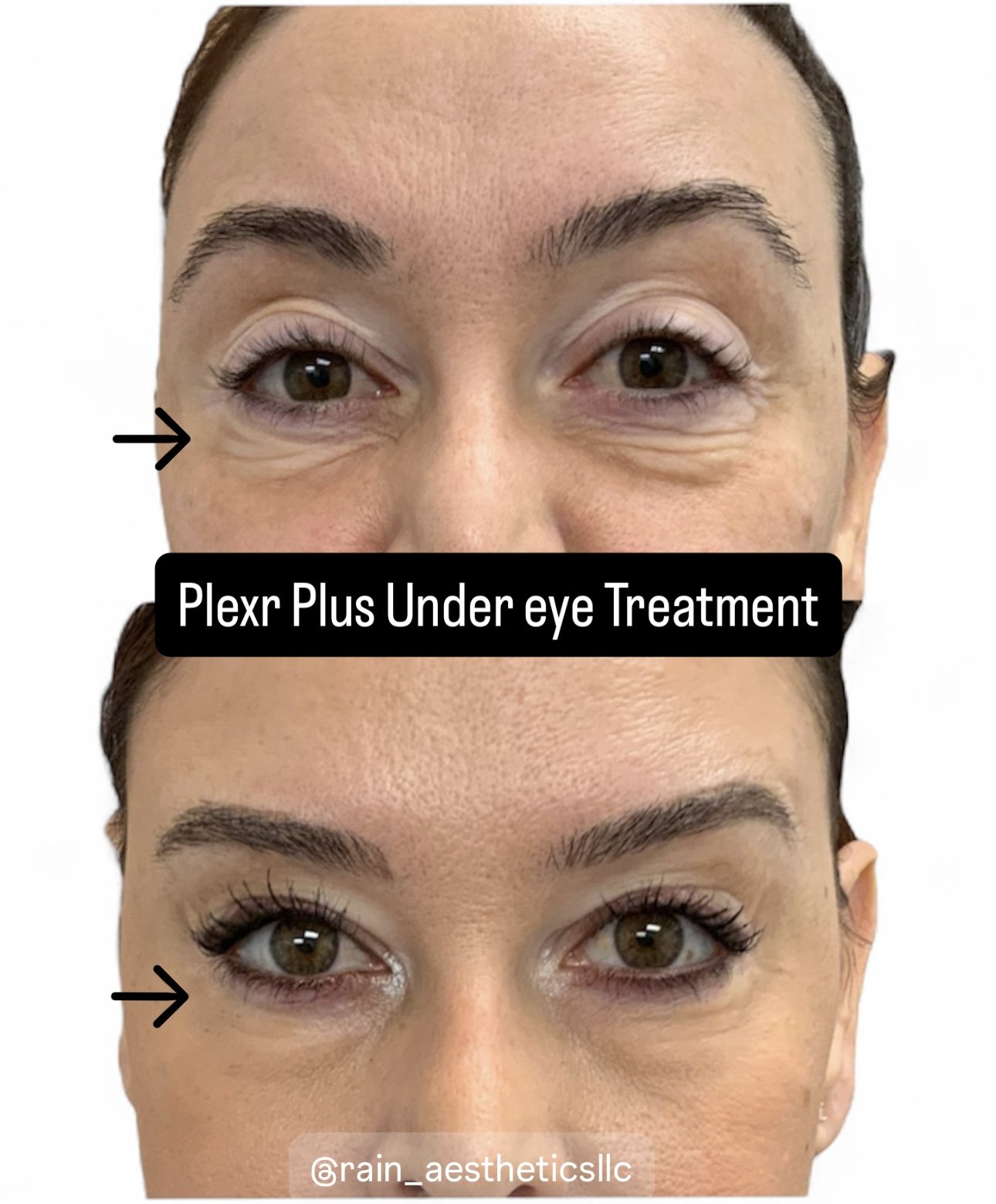 Before and after PLEXR Plus plasma under-eye treatment showing improvement in the appearance of under-eye skin at Rain Aesthetics in Glendale, AZ.
