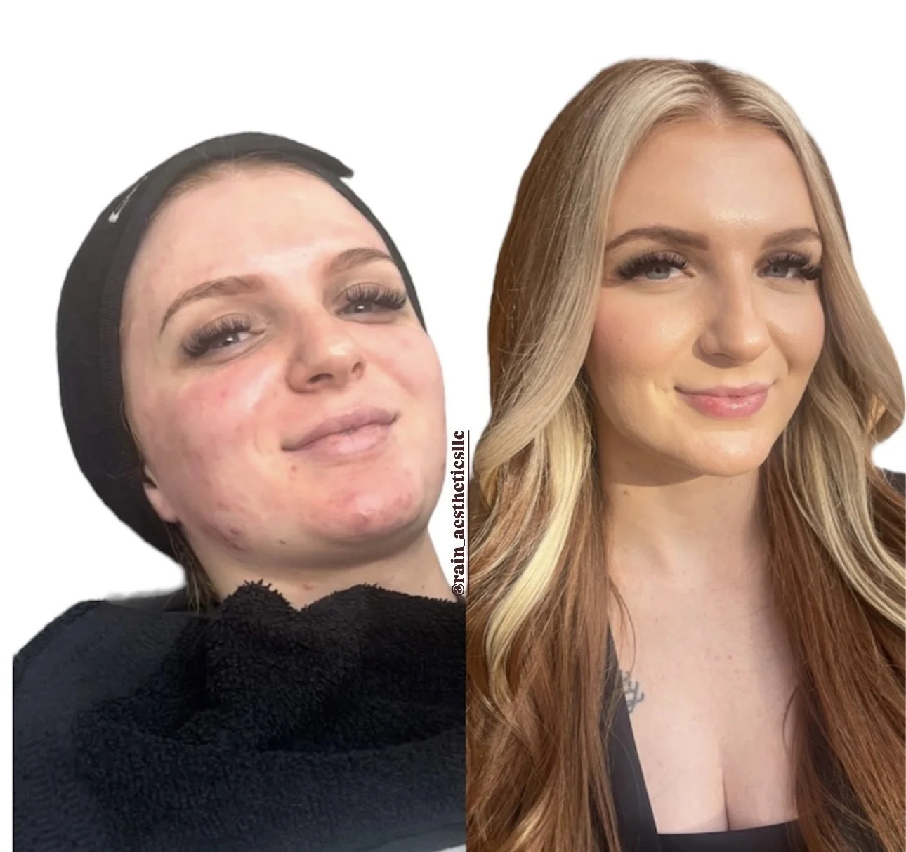 Before and after SkinPen microneedling for acne scars showing improved skin texture at Rain Aesthetics in Glendale, AZ.