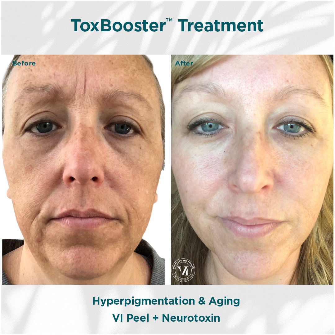 Before and after VI Peel ToxBooster treatment showing improvement in sun damage and overall skin appearance at Rain Aesthetics in Glendale, AZ.