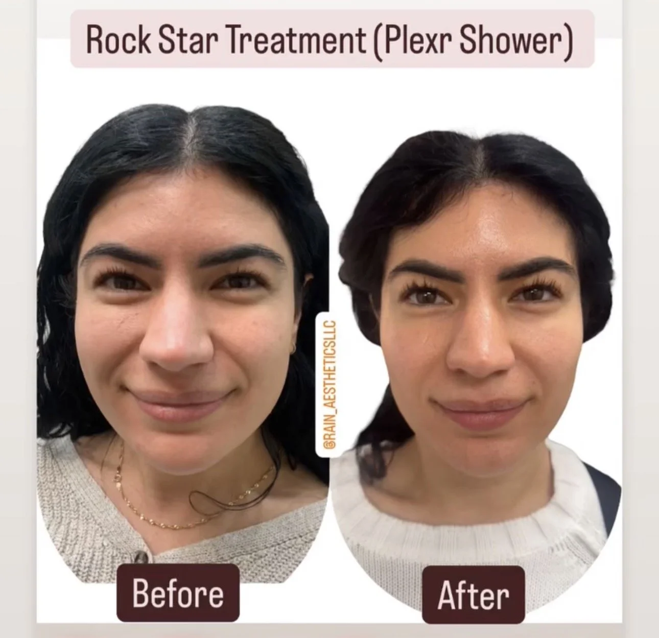 Before and after PLEXR Shower Rock Star treatment showing improvement in overall skin appearance, pores and texture.