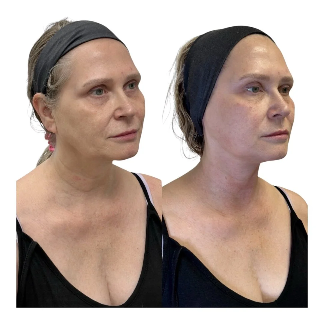 Before and after Xerf Radiofrequency skin tigtening at Rain Aesthetics in Glendale, Arizona, showing visible improvement in eyebrow position, smile lines, jawline definition, and neck skin laxity after 1 session. Performed by Yagmur Sevindik NP