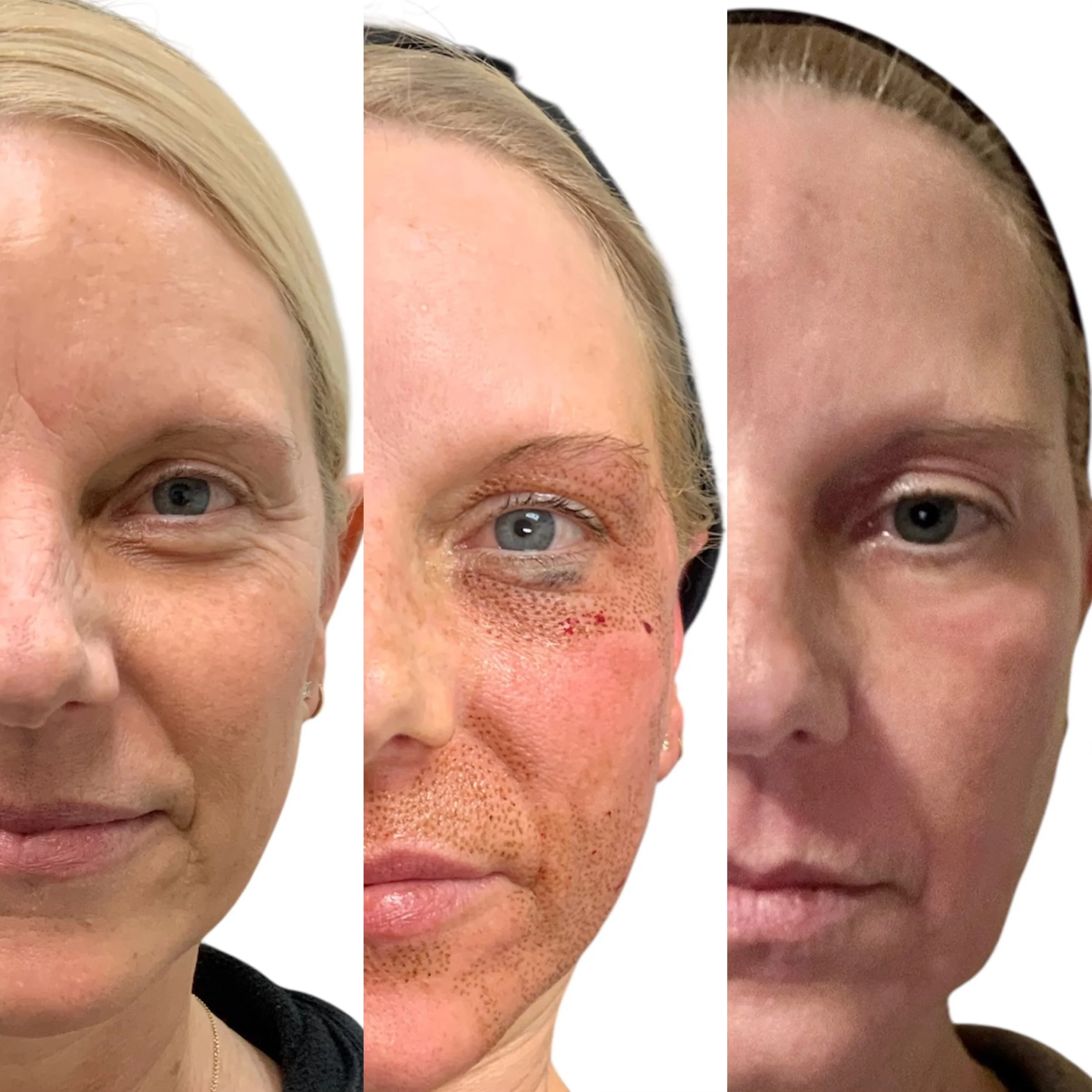 Before and after PLEXR Plus fibroblast treatment around the eyes for non-surgical eye rejuvenation at Rain Aesthetics in Glendale, AZ.